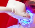Laser Treatment on Teeth - VishwaRaj Hospital