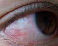 Eye with Glaucoma - VishwaRaj Hospital