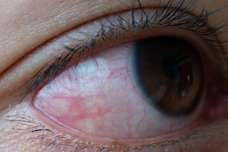 Eye with Glaucoma - VishwaRaj Hospital