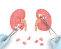 myth-kidney-disease-is-curable