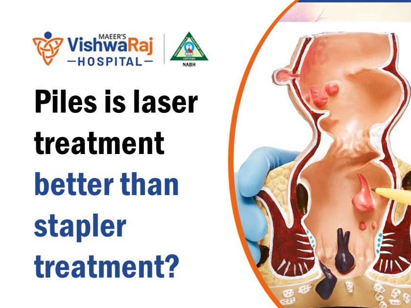 Piles is laser treatment better than stapler treatment? - Best Hospital in  Pune MAEER'S VishwaRaj Hospital, VishwaRaj Hospital, MAEER'S VishwaRaj  Clinic Amanora