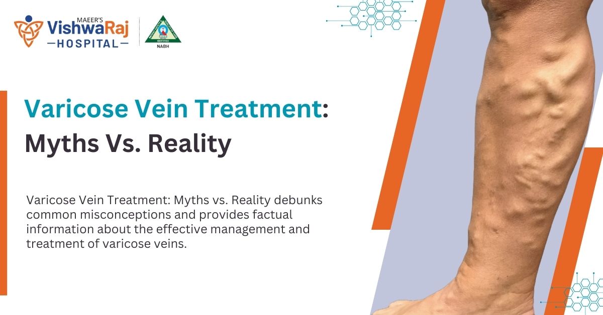 Varicose Vein Treatment Myths vs. Reality: Dispelling Misconceptions for Informed Decisions