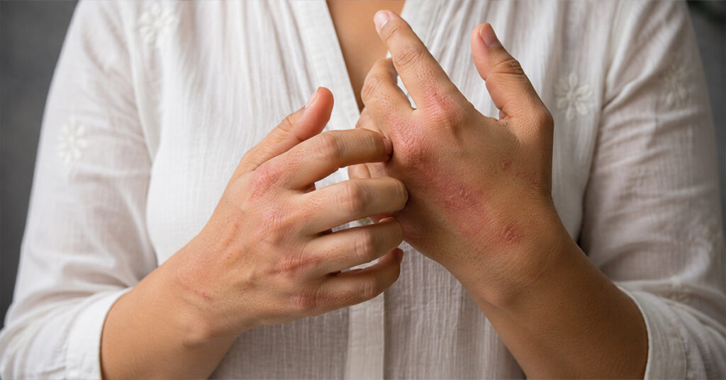 Autoimmune Diseases