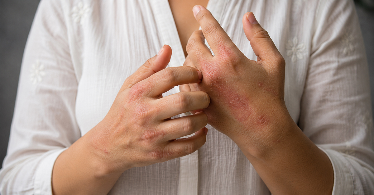 Autoimmune Diseases