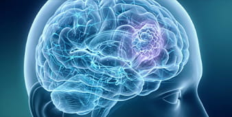VRH Brain Cancer Outer