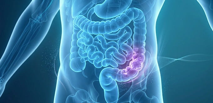 VRH Colorectal Cancer Inner