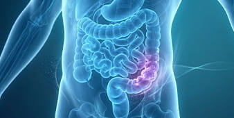 VRH Colorectal Cancer Outer