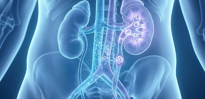 VRH Kidney Stones Inner
