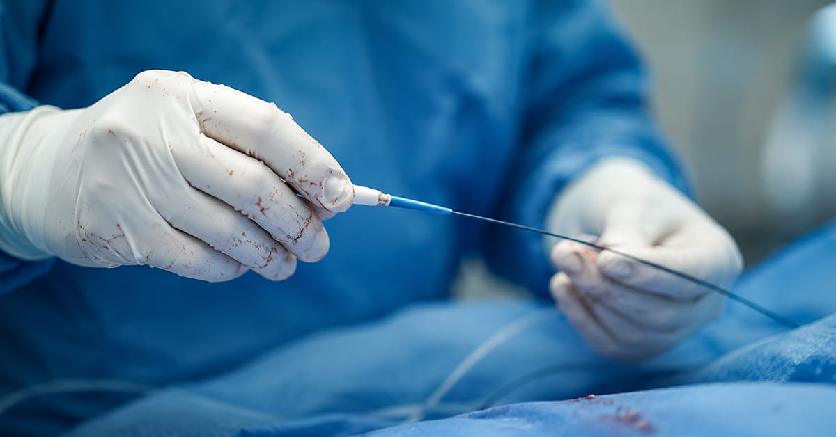 Stentless Angioplasty